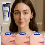 Acne Foaming Wash, Face Cleanser for Acne Treatment, Back Acne Body Wash, Daily Facial Cleanser for Back Acne and Face, 156g