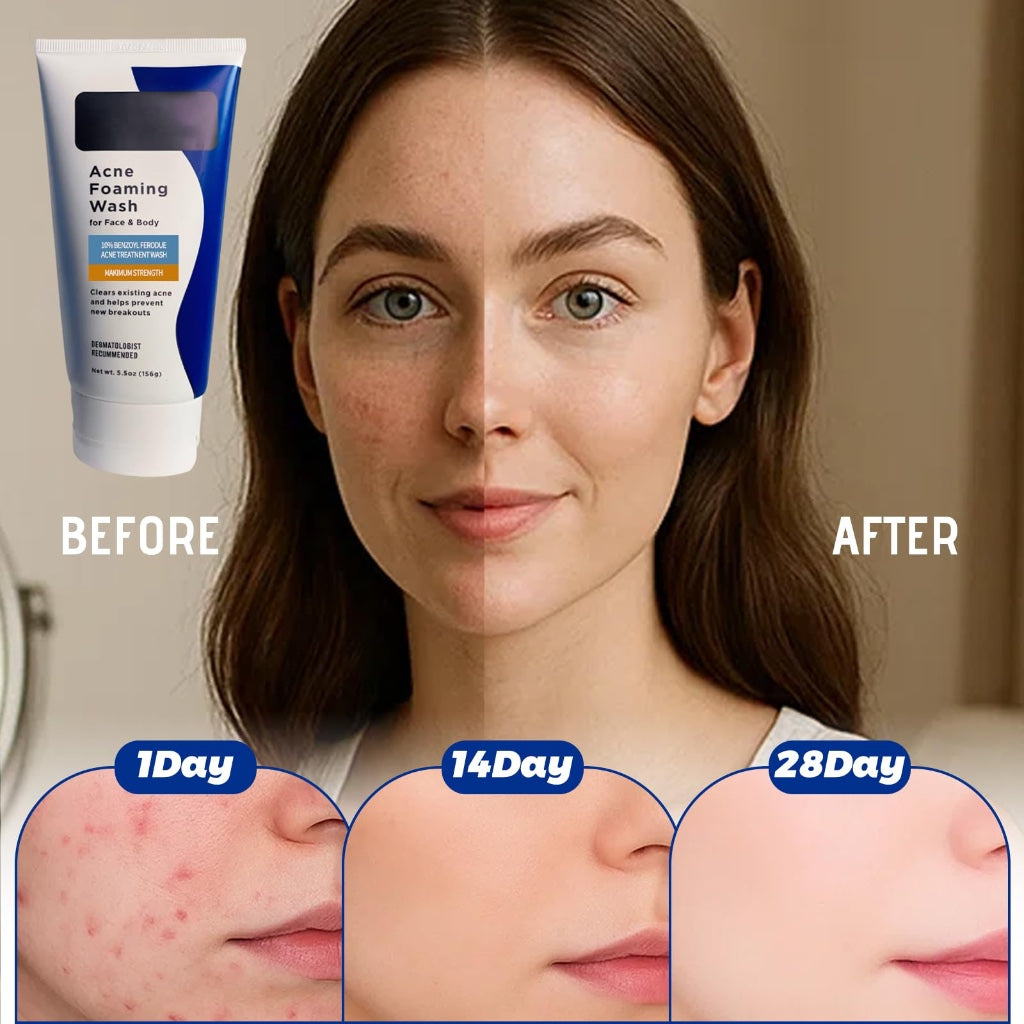 Acne Foaming Wash, Face Cleanser for Acne Treatment, Back Acne Body Wash, Daily Facial Cleanser for Back Acne and Face, 156g