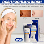 Acne Foaming Wash, Face Cleanser for Acne Treatment, Back Acne Body Wash, Daily Facial Cleanser for Back Acne and Face, 156g