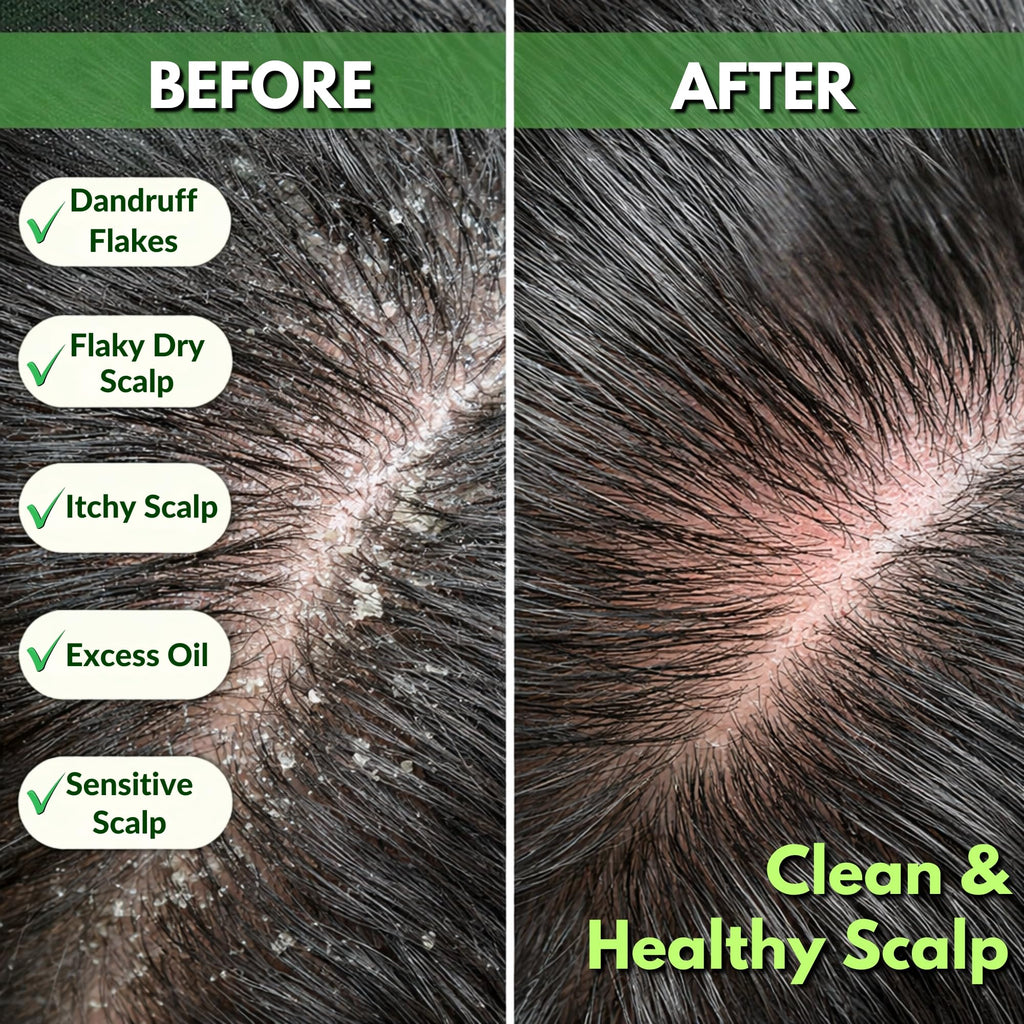Tea Tree Anti-Dandruff Shampoo - For Dry Itchy Flaky Scalp and Dandruff