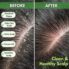 Tea Tree Anti-Dandruff Shampoo - For Dry Itchy Flaky Scalp and Dandruff