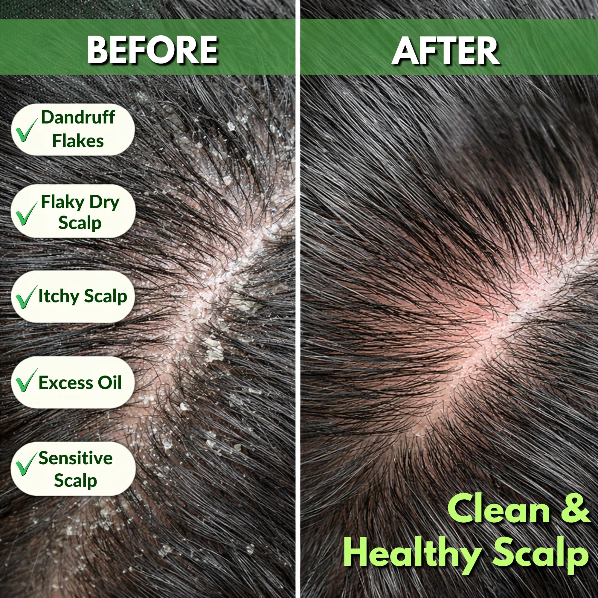 Tea Tree Anti-Dandruff Shampoo - For Dry Itchy Flaky Scalp and Dandruff