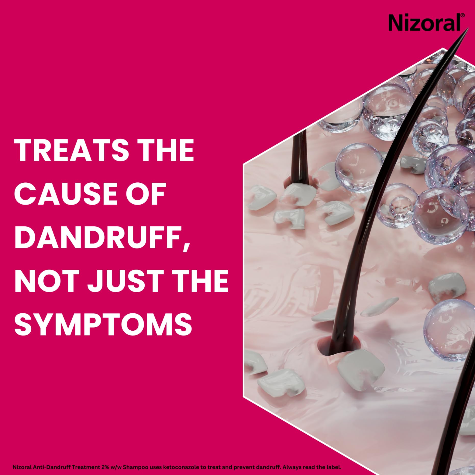 Nizoral Anti-Dandruff Treatment Shampoo, Treats and Prevents Dandruff, Clinically Proven to Control Itchy & Flaky Scalps, Contains Ketoconazole, 1 x 100ml - Damaged Box - BBE 11/2028