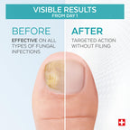 PODERM - FUNGAL NAIL TREATMENT - Nail Fungus Treatment for Toenail - Exceptional and Powerful Plants Anti-Fungal Restorative Properties - Professional Foot/Hand Treatment - Quick&Easy - Swiss Made - Damaged Box