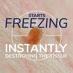 Scholl Freeze Away Skin Tag Removal Kit - Removes Skin Tags in As Little As 1 Treatment - Safe and Effective Skin Tag Remover - Clinically Proven, 12 Treatments - Damaged Box - BBE 04/2028