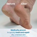Flexitol Cracked Heel Balm 112g - Foot Cream for Dry Skin and Hard Skin Removal - 25% Urea Formula - Suitable for Diabetics - Damaged Box - BBE 11/2028