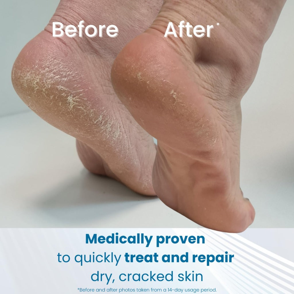 Flexitol Cracked Heel Balm 112g - Foot Cream for Dry Skin and Hard Skin Removal - 25% Urea Formula - Suitable for Diabetics - Damaged Box - BBE 11/2028