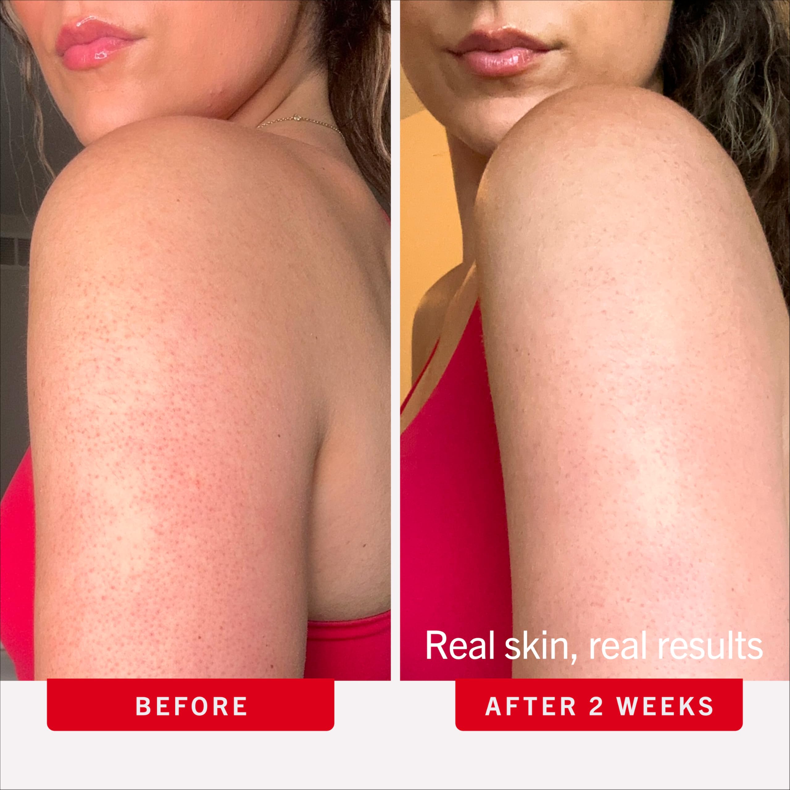 First Aid Beauty KP Bump Eraser Body Scrub 10% AHA 226g 8oz Strawberry Exfoliating Treatment for Keratosis Pilaris and Chicken Skin Bumps - Damaged Box