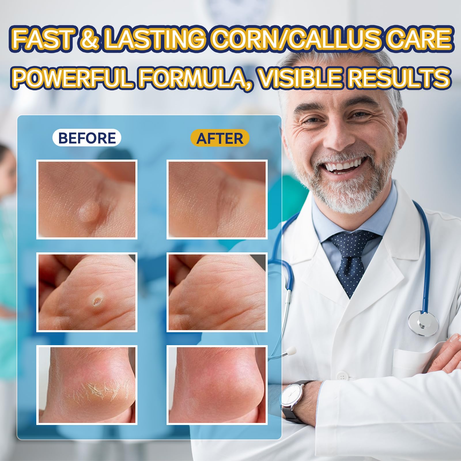 Extra Strength Liquid Corn Remover for Feet - Fast Acting 20ml 1-Pack - Damaged Box