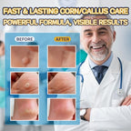 Extra Strength Liquid Corn Remover for Feet - Fast Acting 20ml 1-Pack - Damaged Box