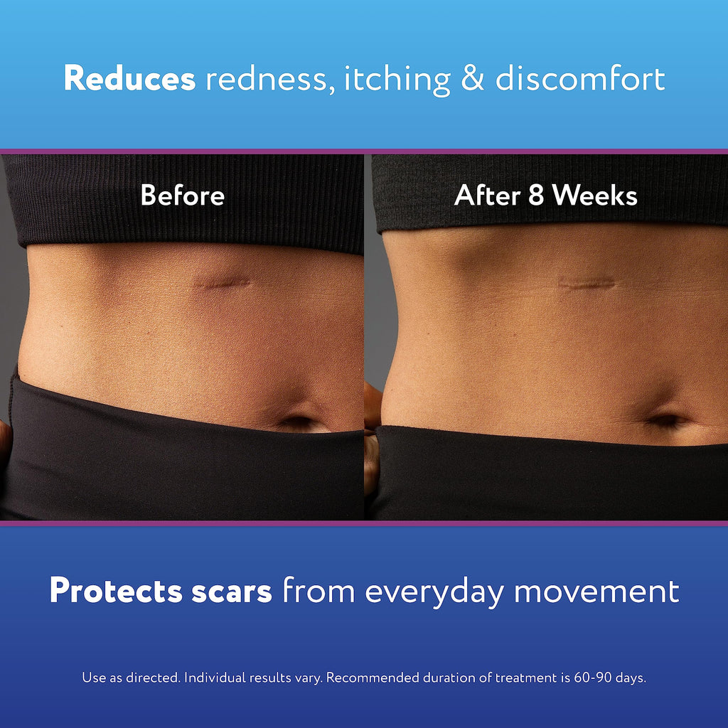 ScarAway Scar Away Scar Repair Gel With Patented Kelo-Cote Technology, 20 Grams - Damaged Box