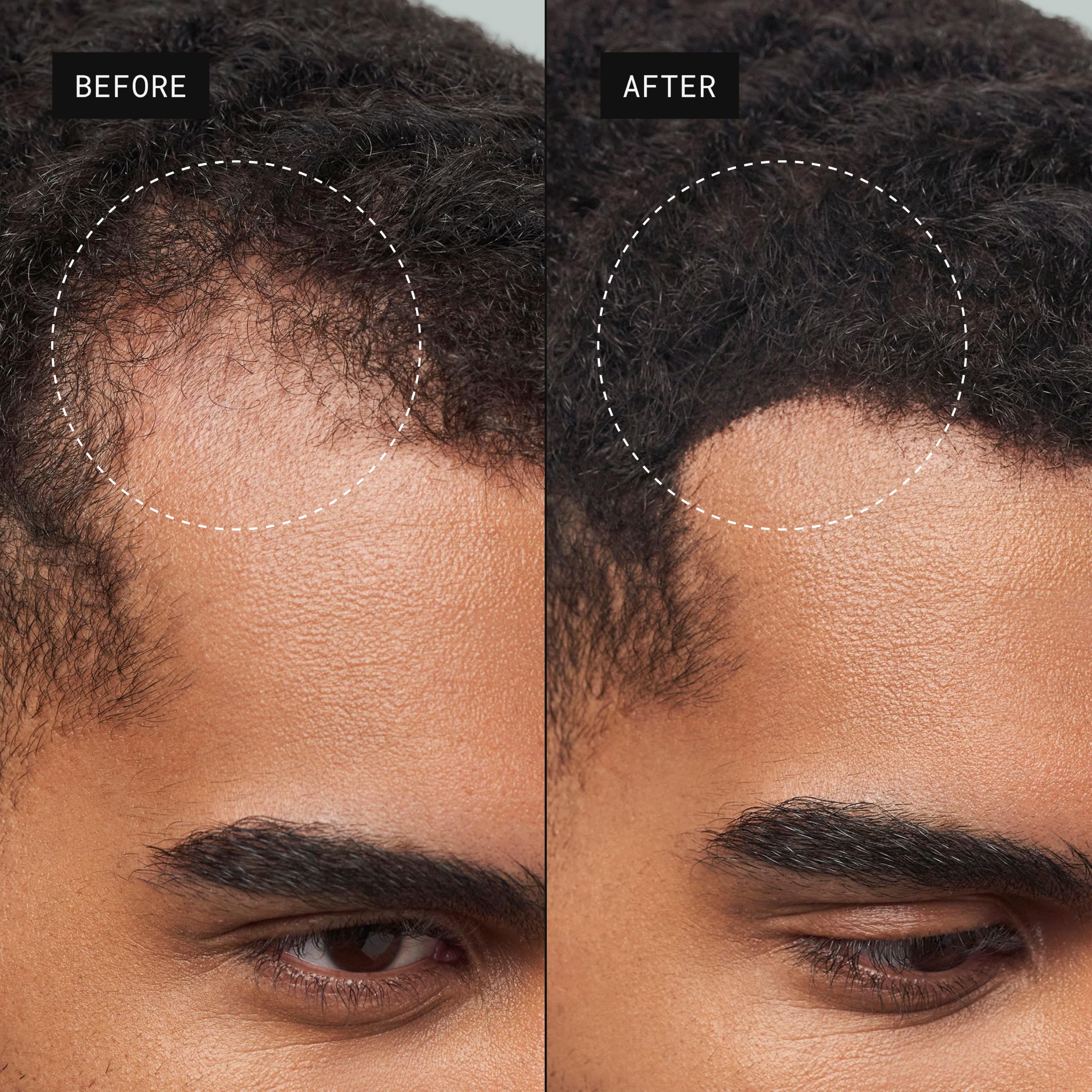 Toppik Hair Building Fibres Powder, Medium Brown, 27.5g Bottle - for A Thicker-looking Hairline, Crown and Beard, Instant Thinning Concealer for Men and Women - Damaged Box