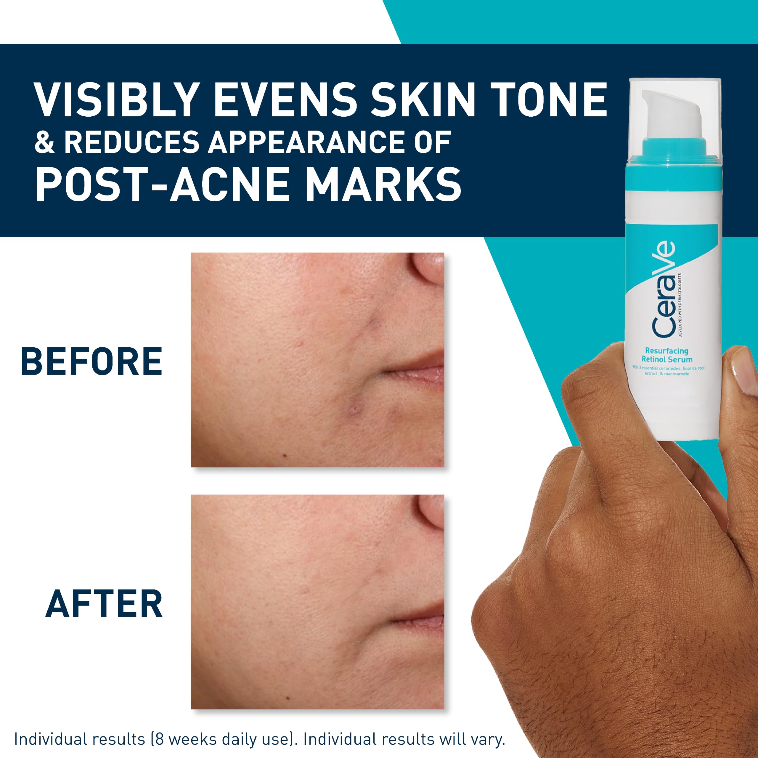 CeraVe Resurfacing Retinol Serum with Ceramides & Niacinamide for Blemish-Prone Skin 30ml, 3 Essential Ceramides, Dermatological Skincare, Hyaluronic Acid - Damaged Box