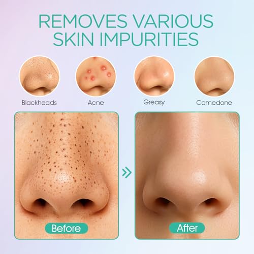 VOYOR Blackhead Remover Vacuum 6 Suction Heads Rechargeable Black Head Remover Tool for Face Pore Vacuum Cleaner Acne Comedone Pimple Whitehead Extractor BR410 - Damaged Box