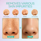 VOYOR Blackhead Remover Vacuum 6 Suction Heads Rechargeable Black Head Remover Tool for Face Pore Vacuum Cleaner Acne Comedone Pimple Whitehead Extractor BR410 - Damaged Box