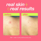 Dermalogica Clear Start Clarifying Body Spray 177ml - Acne Treatment Skincare