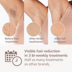 Philips Lumea IPL Hair Removal 8000 Series - Hair Removal Device with SenseIQ Technology, 4 Attachments for Body, Face Bikini and Underarm, Corded Use (Model BRI948/00)