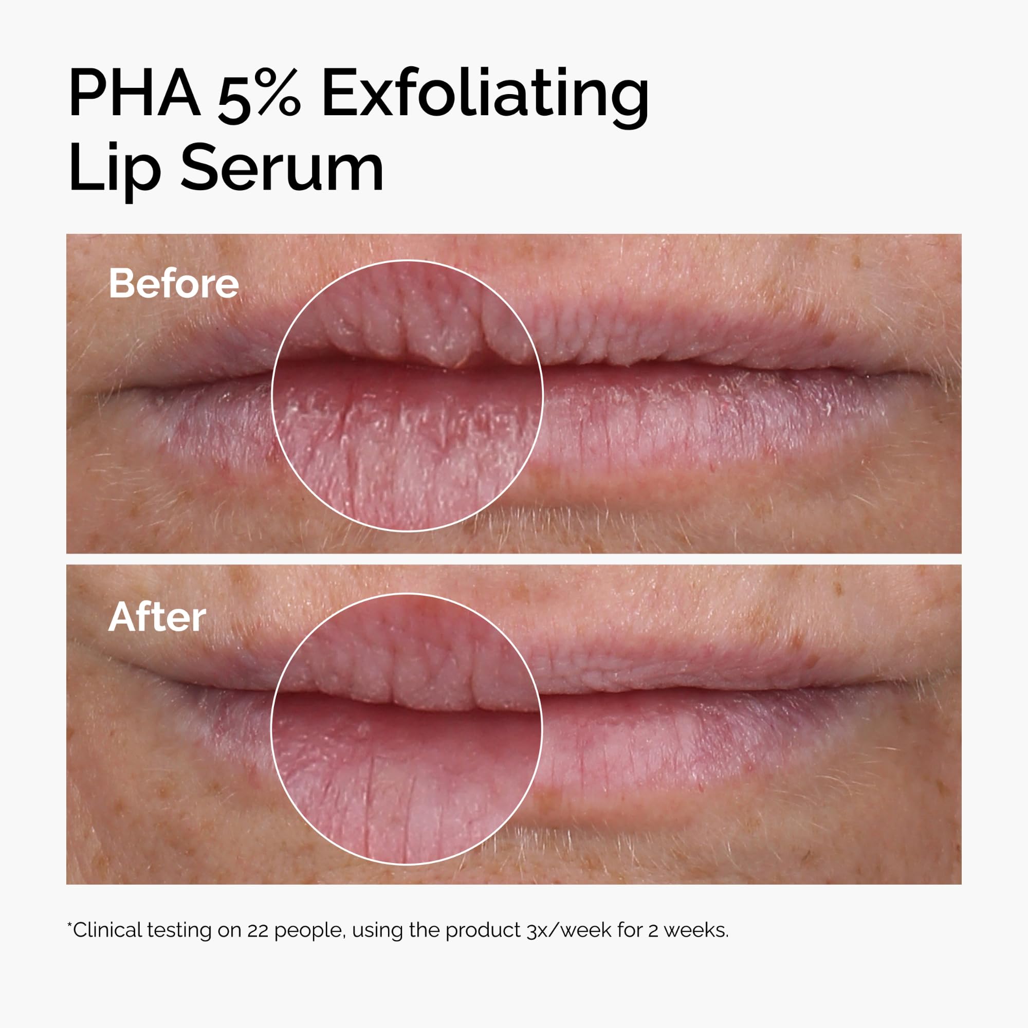 The Ordinary PHA 5% Exfoliating Lip Serum, Hydrating Overnight Lip Exfoliator Treatment, 15ml - Damaged Box