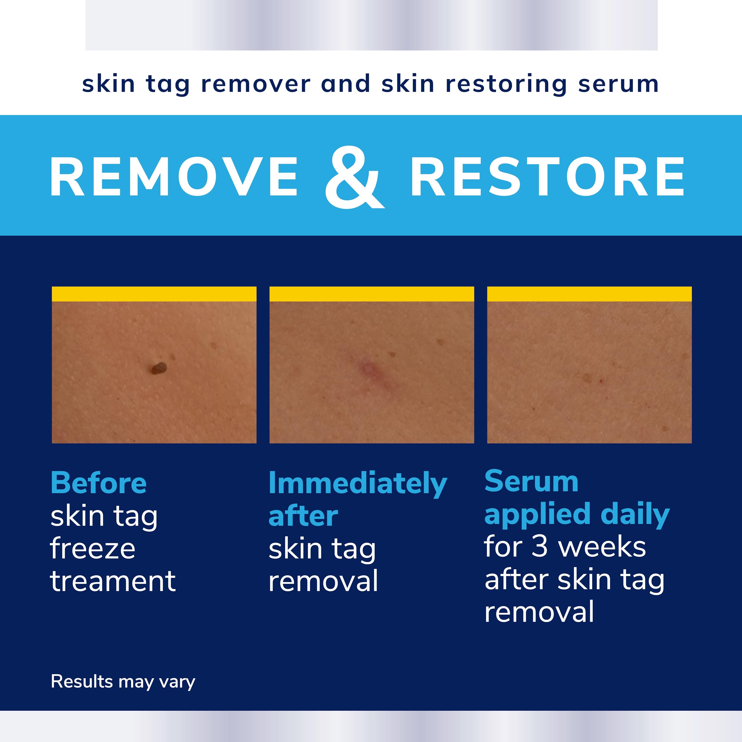 Scholl Complete Care Skin Tag Removal Kit - Safe & Effective Skin Tag Remover - Moisturising Serum Restores Skin's Appearance - Clinically Proven - 12 Treatments Plus Hydrating Serum - Damaged Box - BBE 04/2027