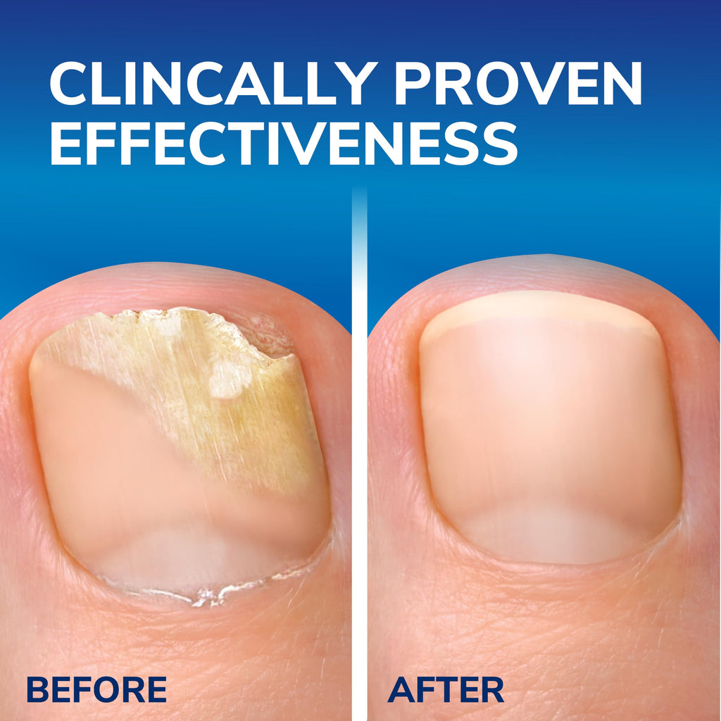Scholl Fungal Nail Treatment 3.8ml,packaging may vary - Damaged Box - BBE 04/2028