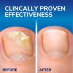 Scholl Fungal Nail Treatment 3.8ml,packaging may vary - Damaged Box - BBE 04/2028