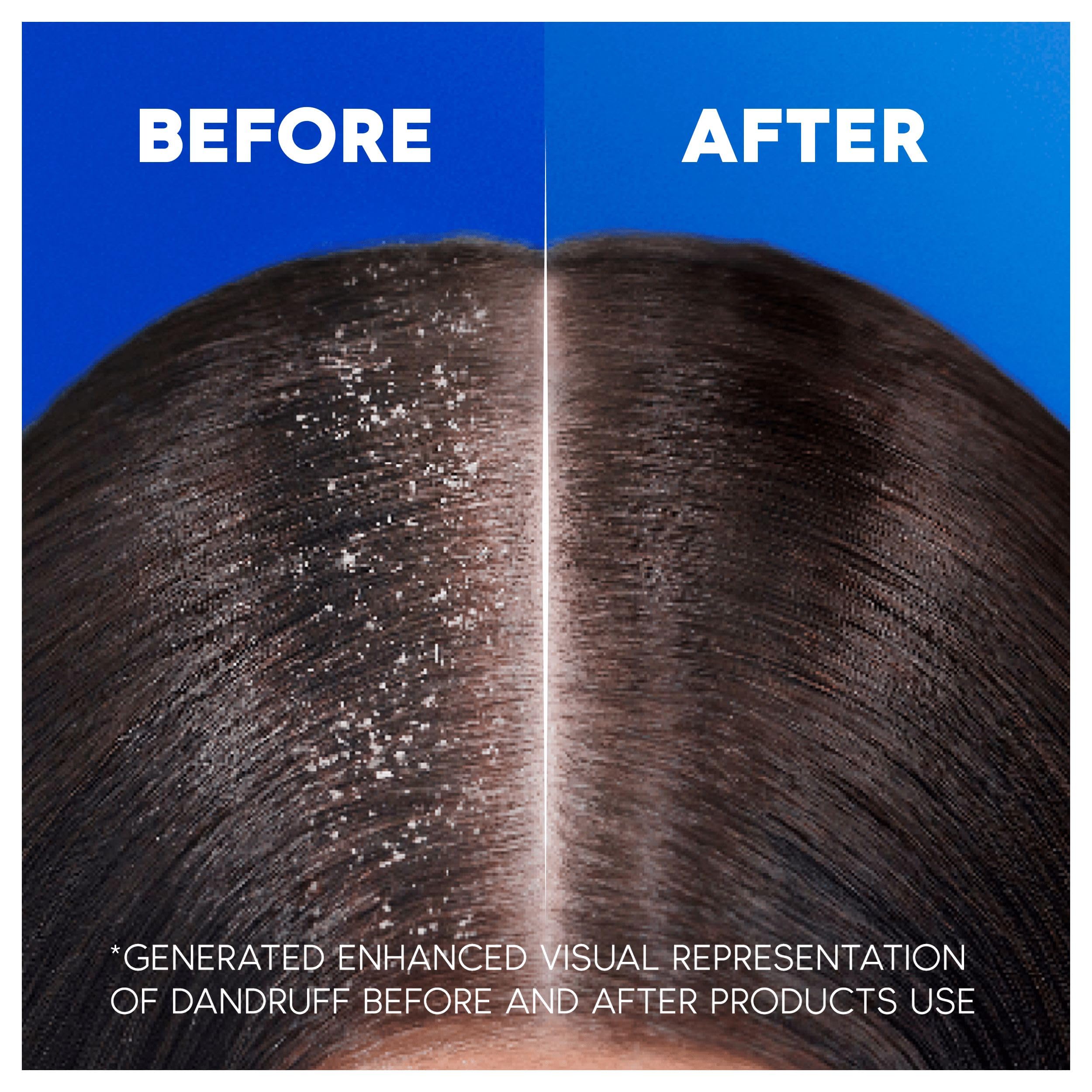 Head & Shoulders Apple Fresh Anti-Dandruff Shampoo 1000ml - Flake Free Daily Use for All Hair Types - New