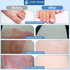 Terthon Herbal Antifungal Cream - Ringworm, Jock Itch, Athlete's Foot Treatment - Fungal Skin Infection Relief 20g 1 Pack - New - BBE 03/2028