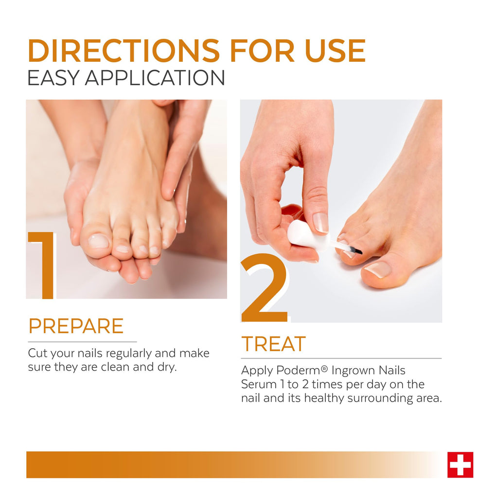 Poderm Emollient Ingrown Toenail Treatment - Swiss-Made Nail Softener for Thick Curved Nails - Pain Relief, Callus Softener - Damaged Box - BBE 03/2029