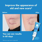 KELO-COTE Kids Silicone Scar Gel 6g - Gentle Treatment for Sensitive Skin - Reduces Raised Scars - Surgical Burn Acne - Damaged Box - BBE 09/2026