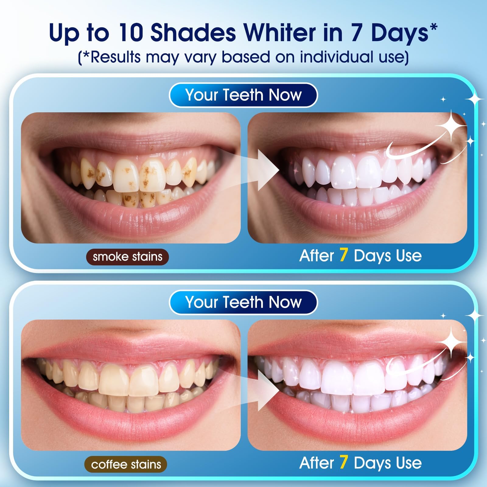 Teeth Whitening Kit with LED Light - 3 Teeth Whitening Gel Pens + 2 Remineralizing Desensitizing Gel Pens -35% Pap Whitening Formula - Whiten Teeth in 7 Days - Safe for Sensitive Teeth (Mint) - Damaged Box