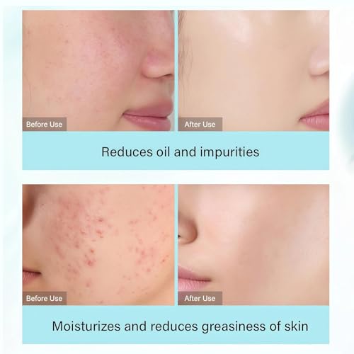 Skin Care Sets & Kits With Tea Tree - Complete Zits Care Kit For Women, Cleanser Toner Serum Cream - Skin Cares Gift Sets For Women, Oily Skins Cares - Damaged Box