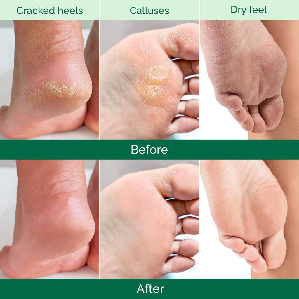 PLANTIFIQUE Foot Peel Mask, Dermatologically Tested Foot Treatment, 2 Pairs - New