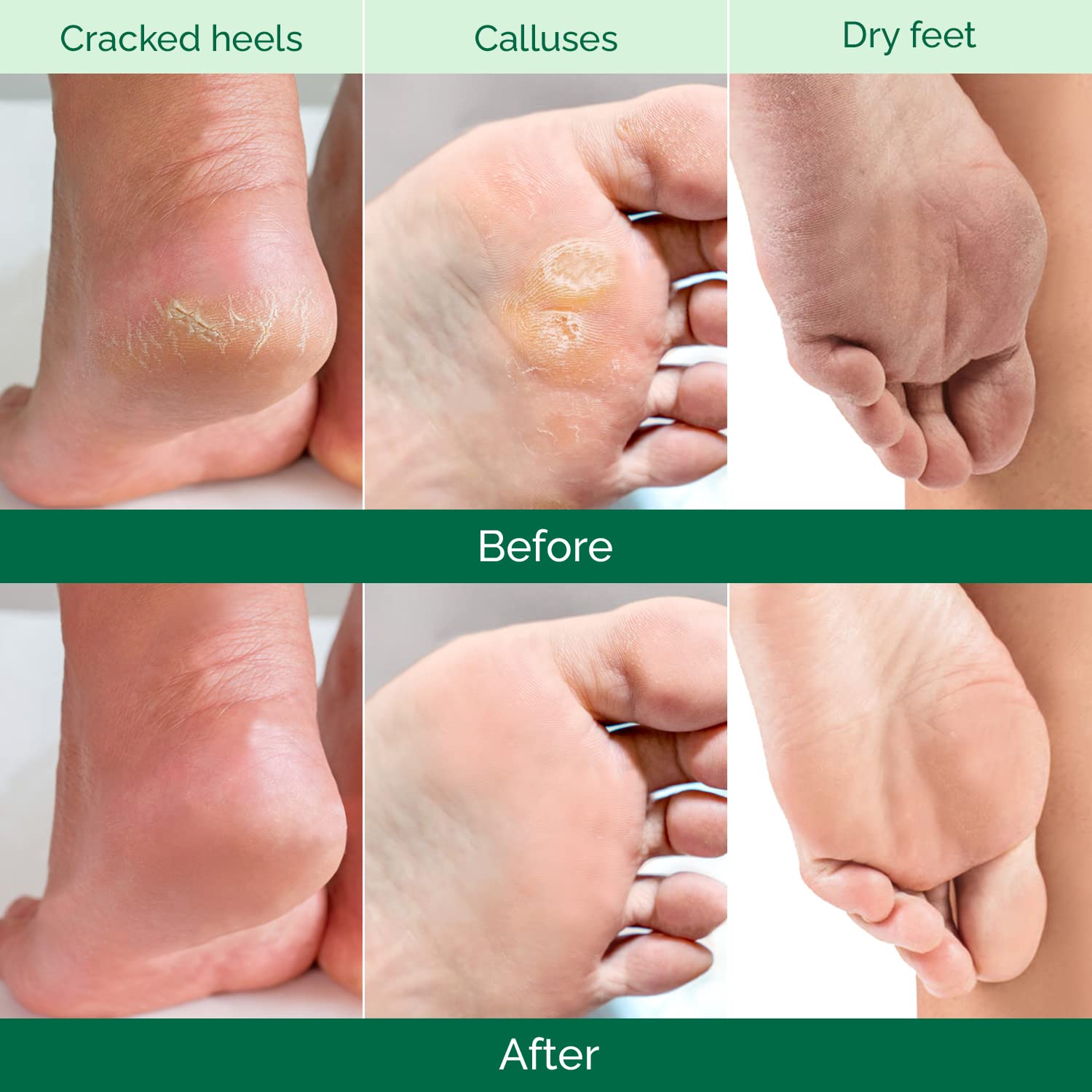 PLANTIFIQUE Foot Peel Mask, Dermatologically Tested Foot Treatment, 2 Pairs - New