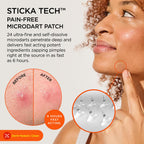 ZitSticka Killa Kit Microdart Pimple Patch For Face - Fast-Acting Acne Spot Treatment - 4 Count - Damaged Box - BBE 02/2028