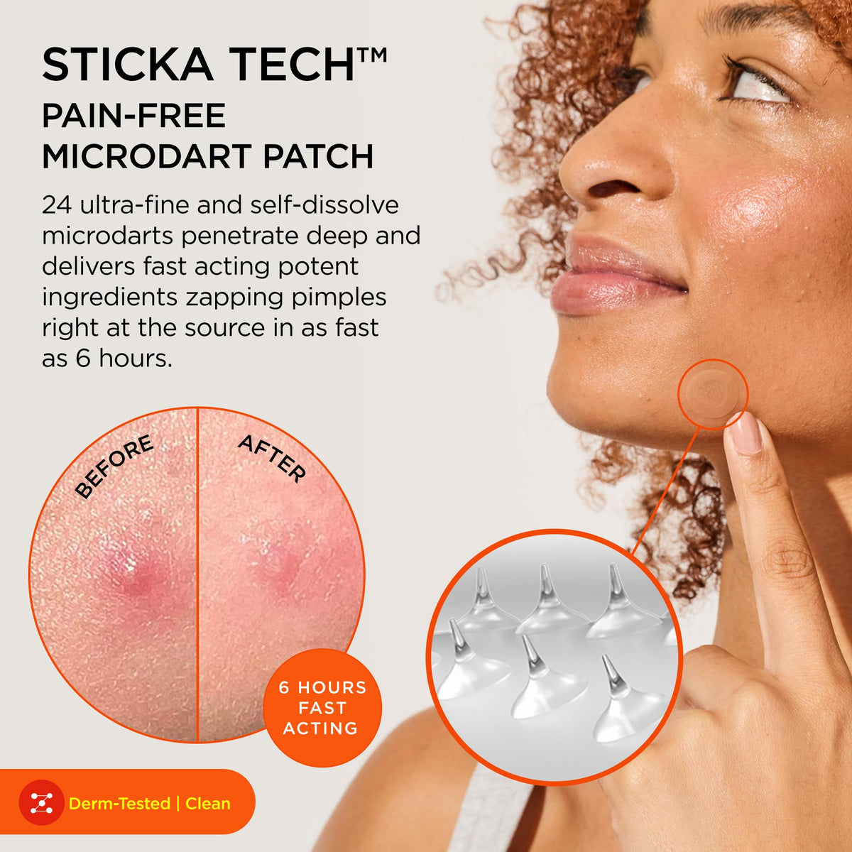 ZitSticka Killa Kit Microdart Pimple Patch For Face - Fast-Acting Acne Spot Treatment - 4 Count - Damaged Box - BBE 02/2028