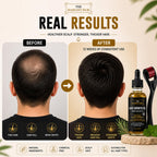 Rosemary Oil for Hair Growth and Derma Roller Kit 60ml - Castor Jojoba Peppermint Coconut Scalp Treatment for Men and Women - Damaged Box