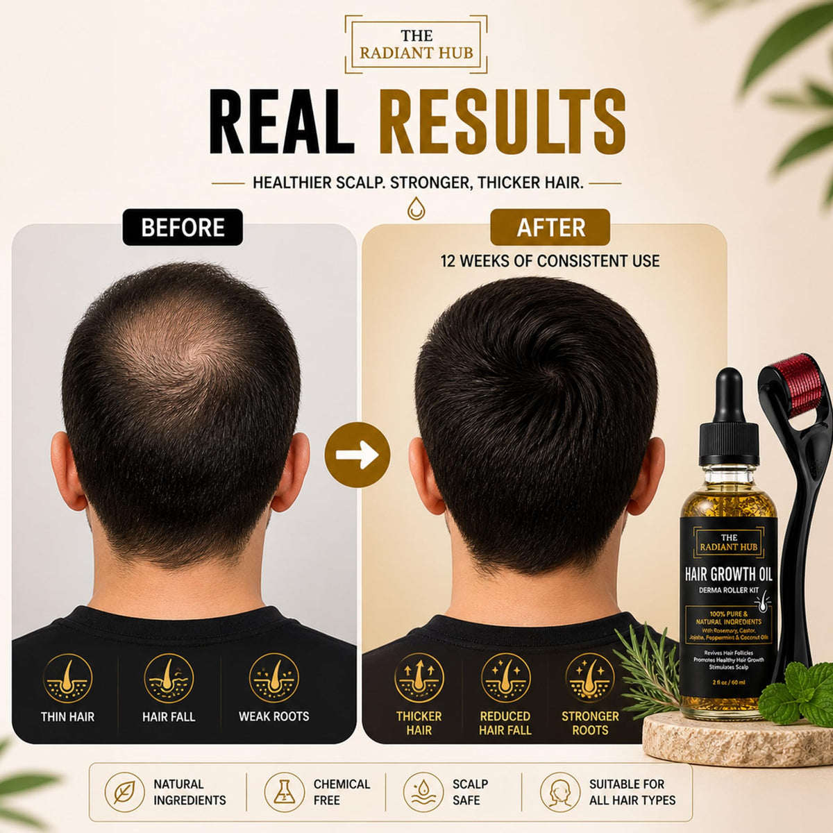 Rosemary Oil for Hair Growth and Derma Roller Kit 60ml - Castor Jojoba Peppermint Coconut Scalp Treatment for Men and Women - Damaged Box